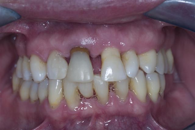 Healthy clean lasered under LANAP protocol gums periodisease reversed
